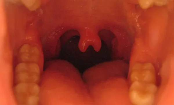 palmon uvula